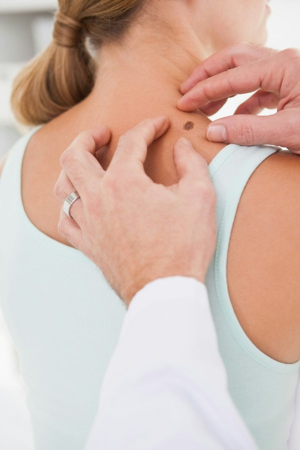 Tache brune sur la peau : les secrets des traitements efficaces